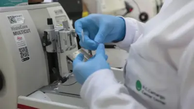SUS incorpora terapia inovadora para leucemia mieloide aguda em adultos
